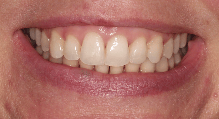 After - Nailsea Dental Practice